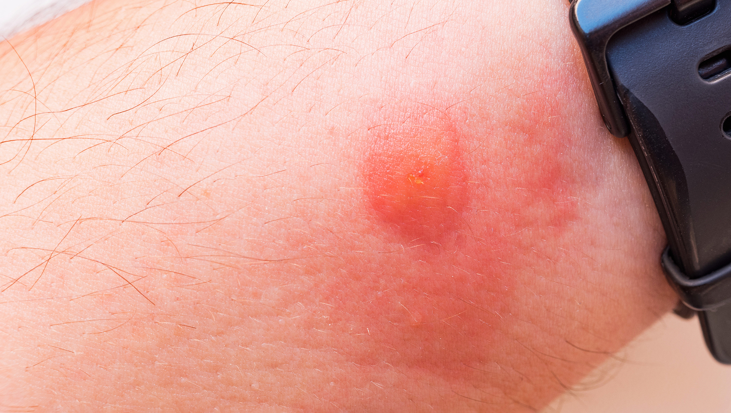 почему мухи кусаются