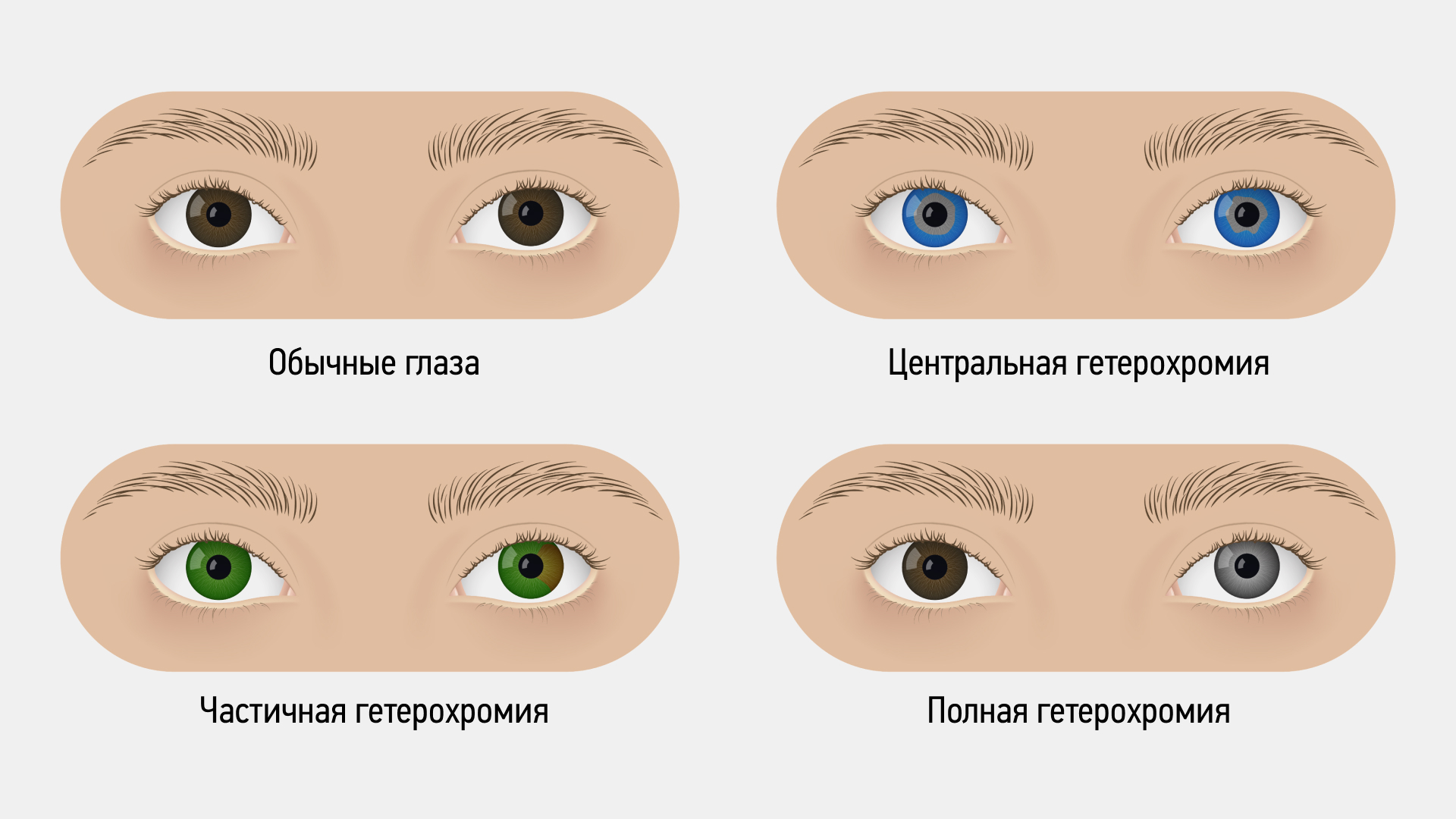 Гетерохромия
